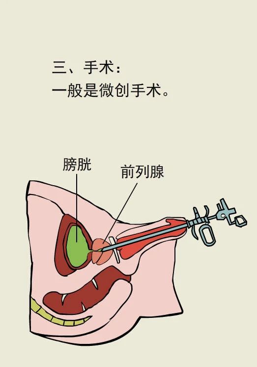 前列腺炎最新治疗技术，科技重塑健康，开启美好生活新篇章